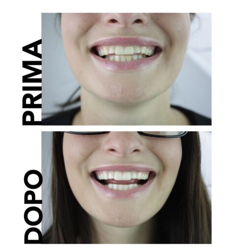 Sbiancamento dei denti prima e dopo